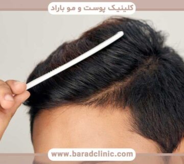 High density hair transplant