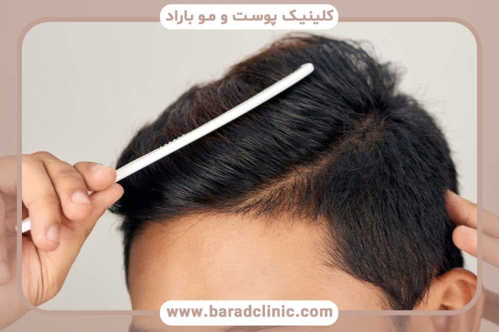 High density hair transplant