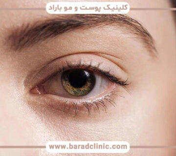 تزریق چربی زیر چشم برای چه کسانی مناسب است؟
