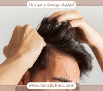 hair transplant