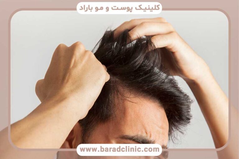 hair transplant