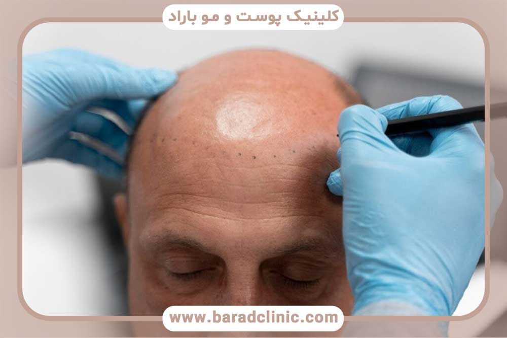 Hair transplantation for people with advanced baldness