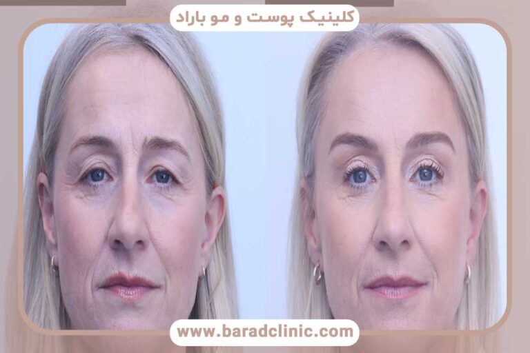 The best blepharoplasty surgeon in the best clinic in North Tehran