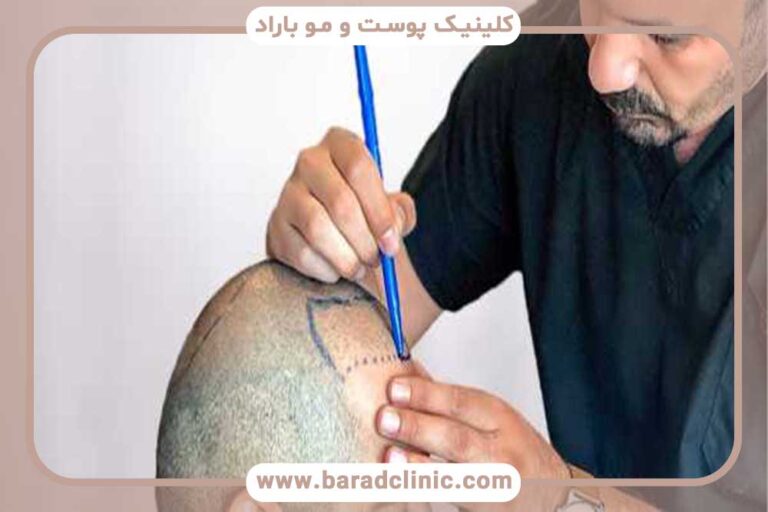 Hair transplantation for diabetic, heart patients and those with specific diseases