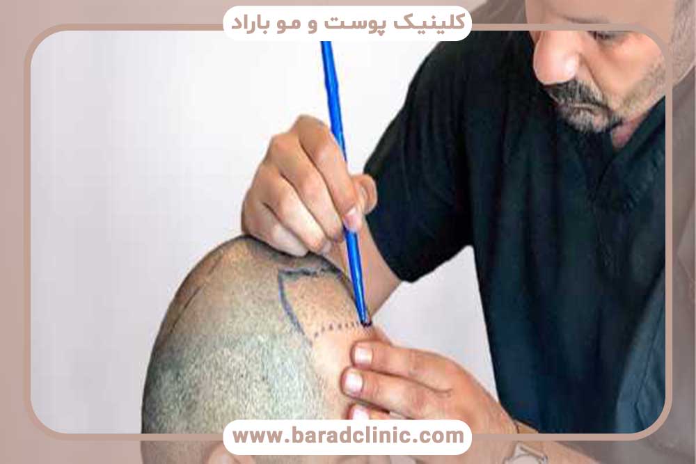 Hair transplantation for diabetic, heart patients and those with specific diseases