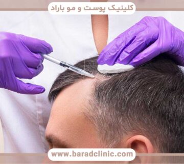 Comparing hair transplantation with PRP and mesotherapy