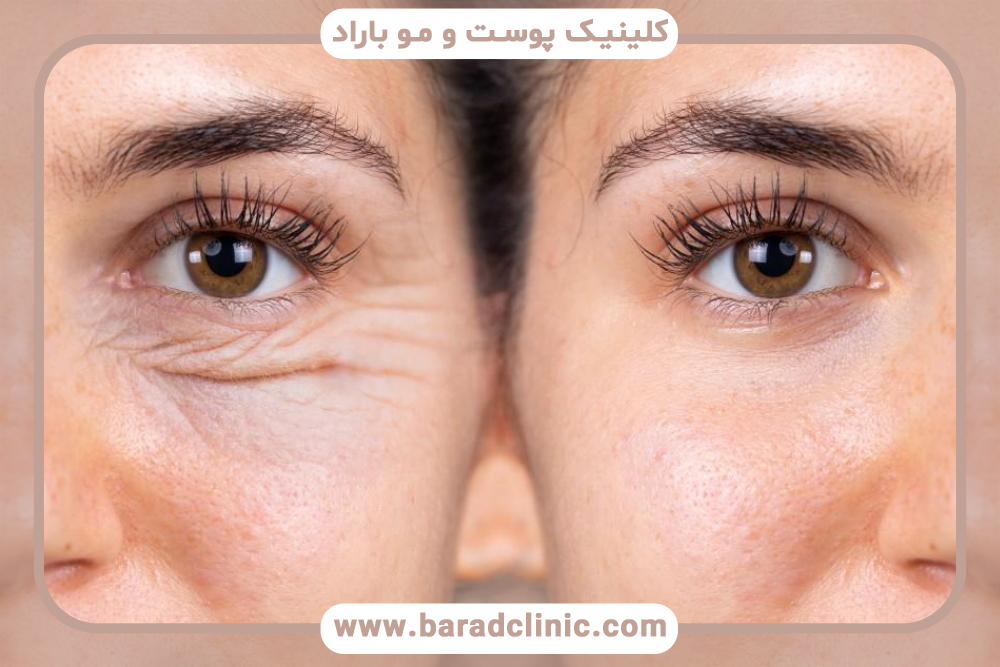 جراحی لیفت ابرو