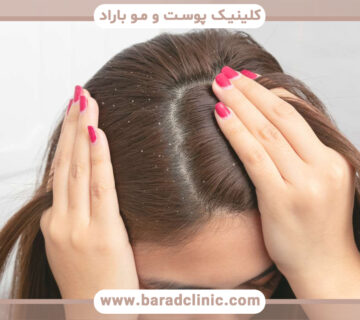 مشکل پوسته سر