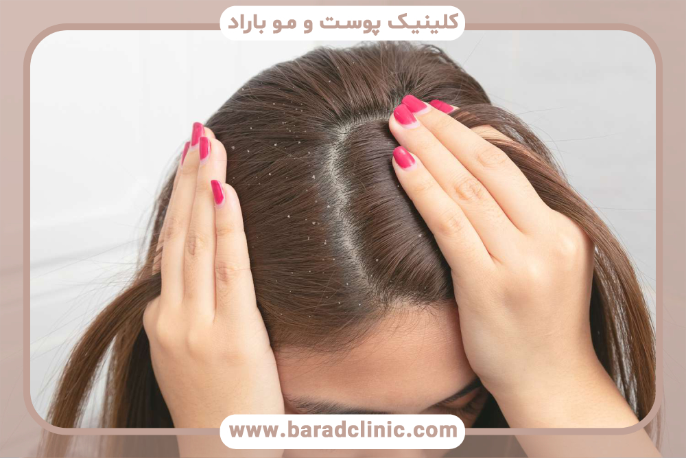 مشکل پوسته سر