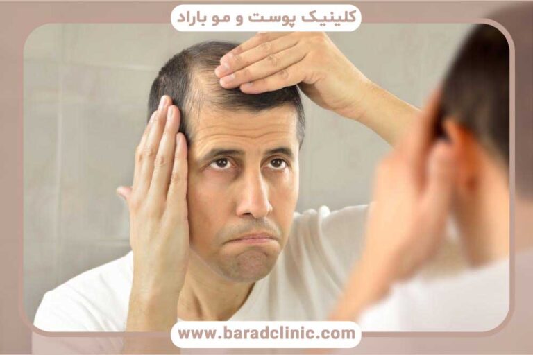 Restoring self-confidence with hair transplantation