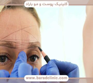 Results of eyebrow transplant