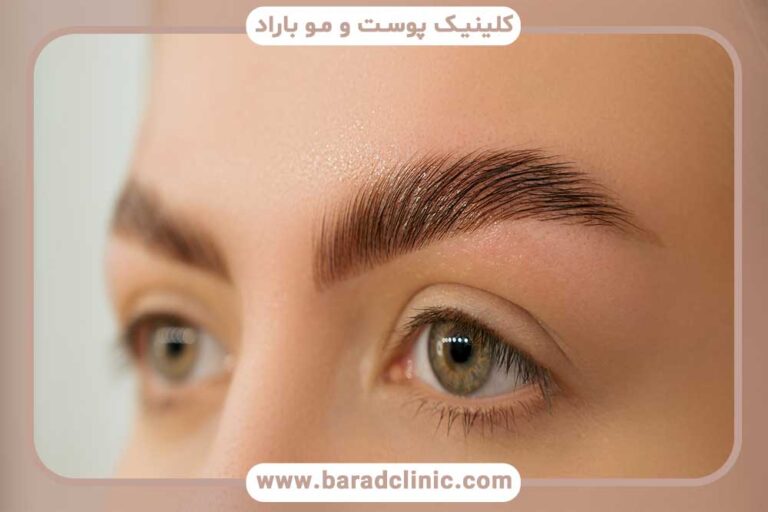 Eyebrow transplantation using the FUE method