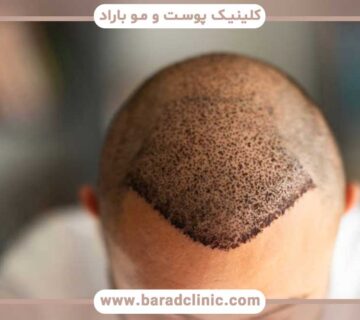 Hair transplant in summer or winter