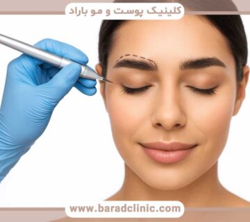 Longevity of eyebrow transplant results