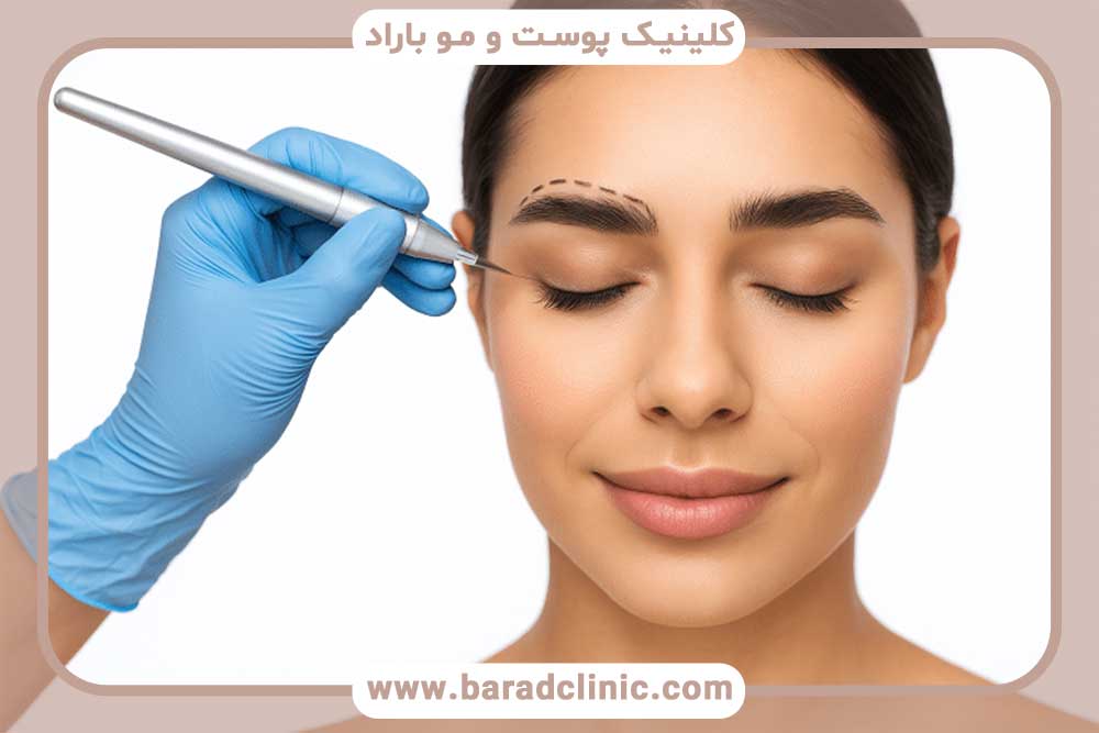 Longevity of eyebrow transplant results