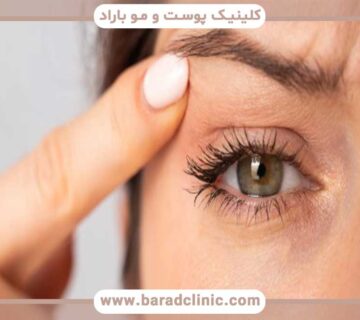 Suitable candidate for blepharoplasty
