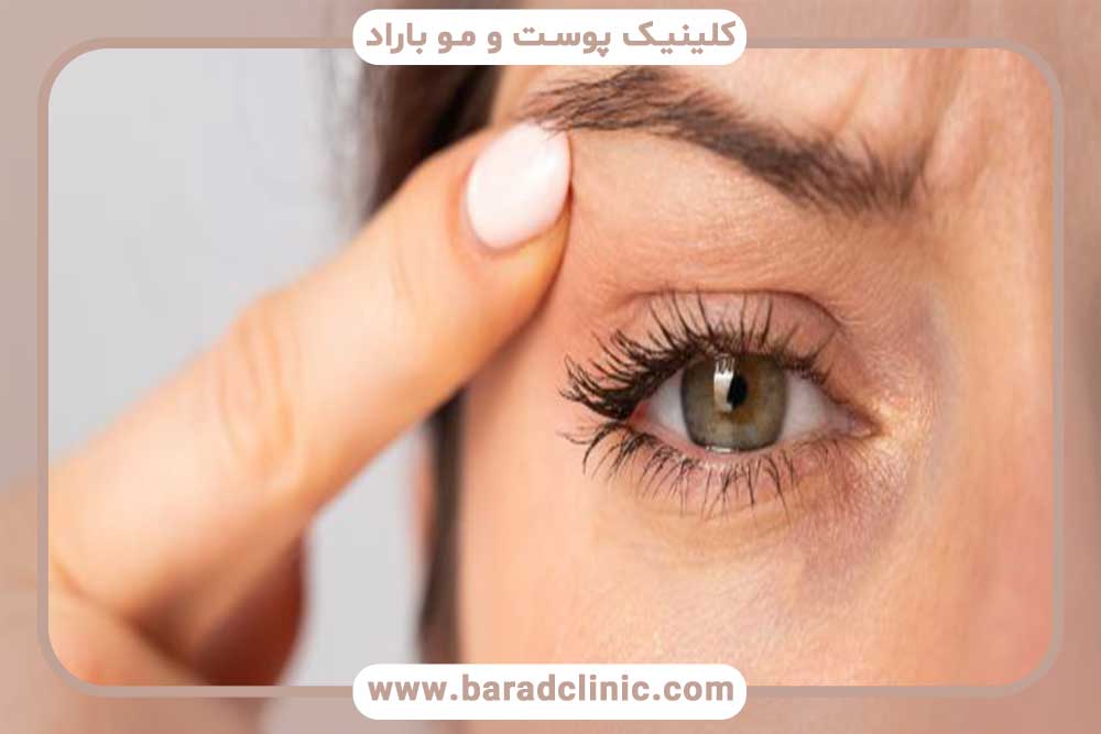 Suitable candidate for blepharoplasty