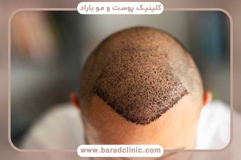 Hair transplant in summer or winter