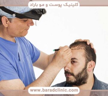 Does hair transplantation cause scars or wounds?
