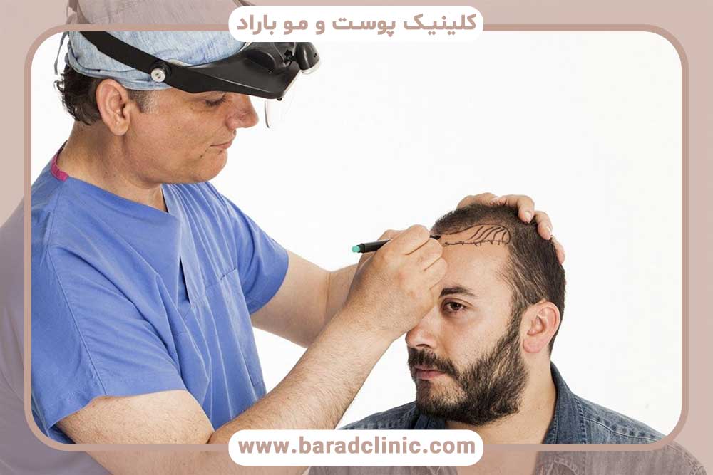 Does hair transplantation cause scars or wounds?