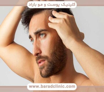 Hair transplantation in the frontal, parietal and temple areas