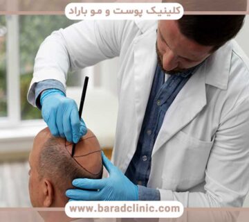 Choosing a doctor who specializes in hair transplant success