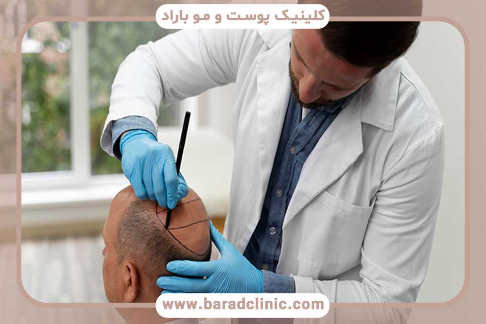 Choosing a doctor who specializes in hair transplant success