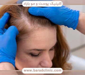 Hair transplant for women