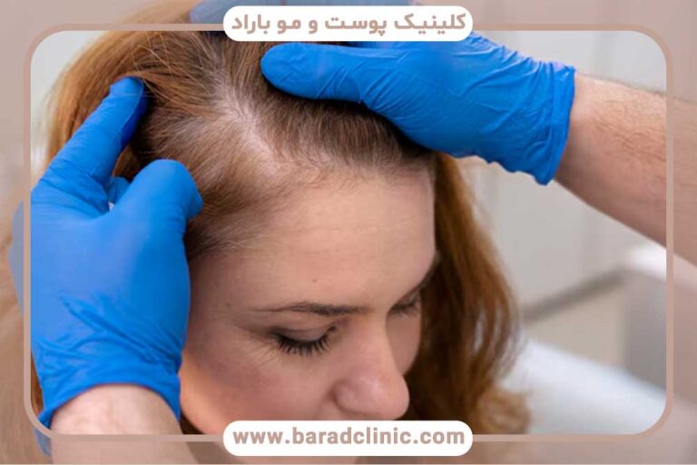 Hair transplant for women