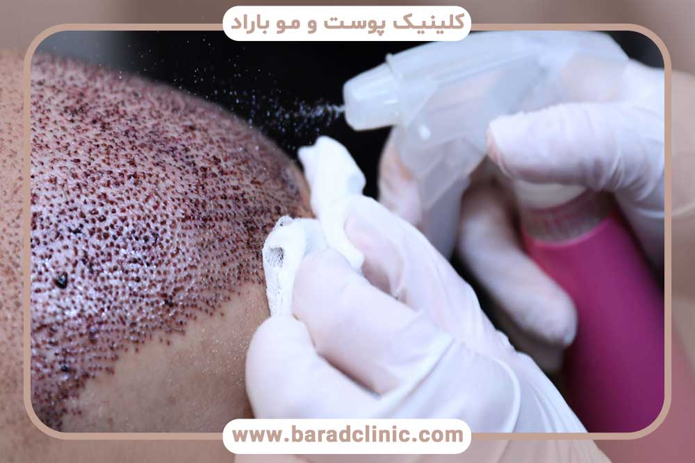 Post-hair transplant care