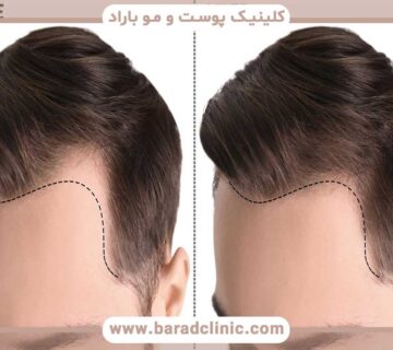 Hair transplantation in the natural hairline