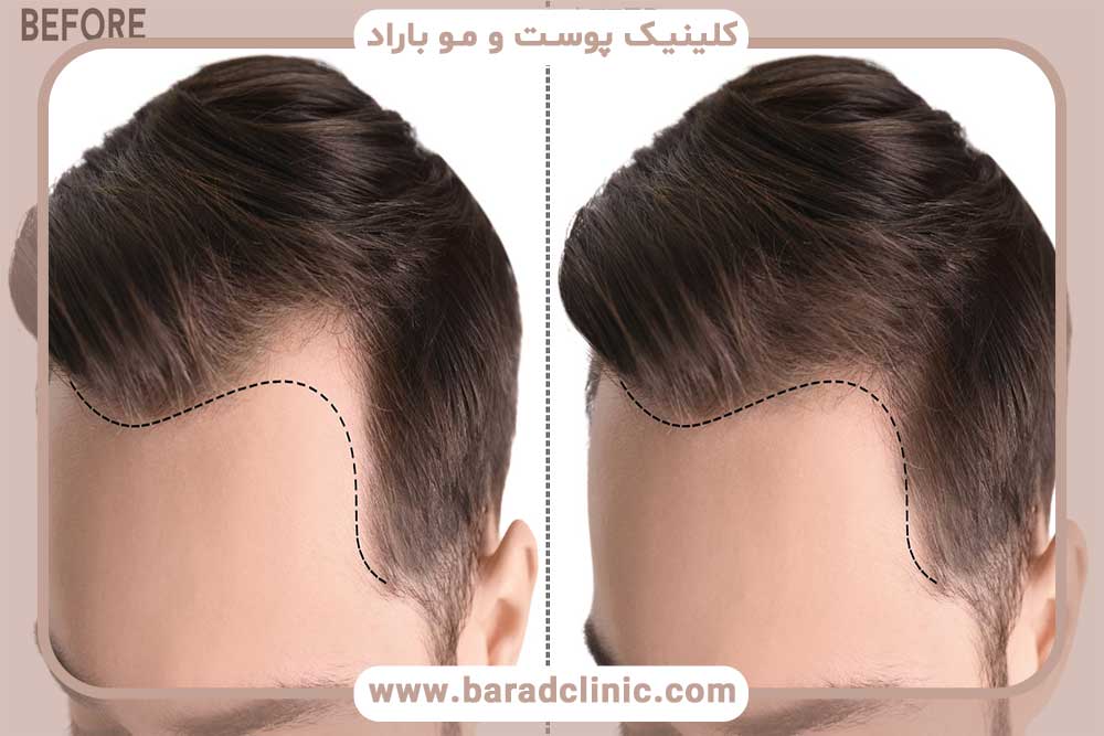 Hair transplantation in the natural hairline