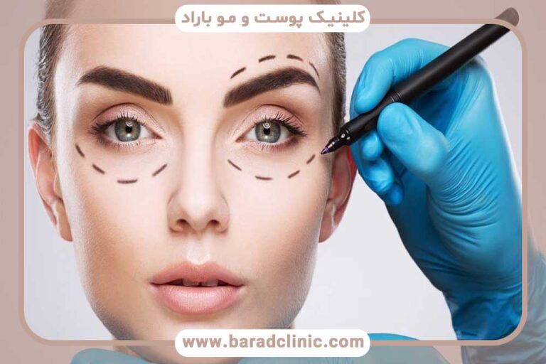 بلفاروپلاستی