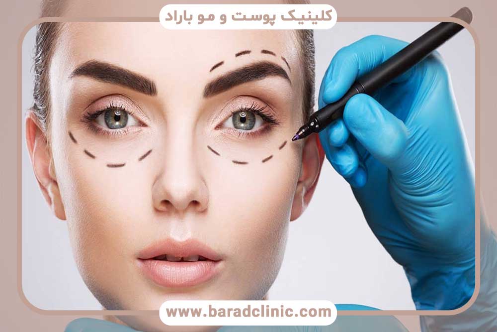 بلفاروپلاستی چیست