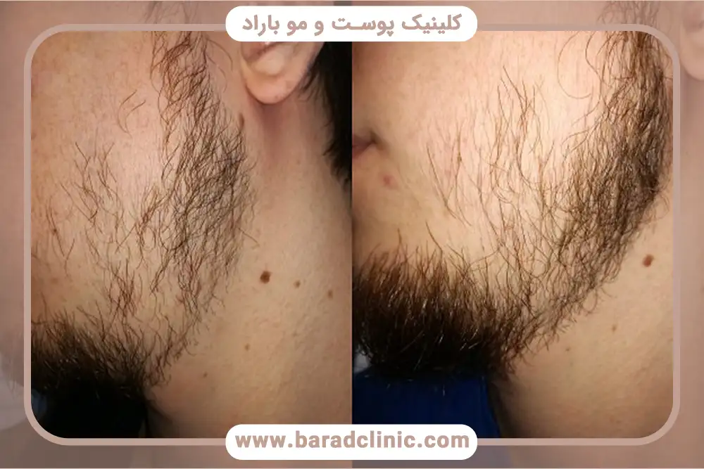 فرایند کاشت ریش به چه صورت است؟