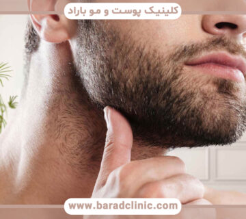 عوارض کاشت ریش و راههای پیشگیری از آن