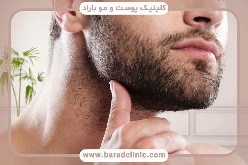 عوارض کاشت ریش و راه‌های پیشگیری از آن