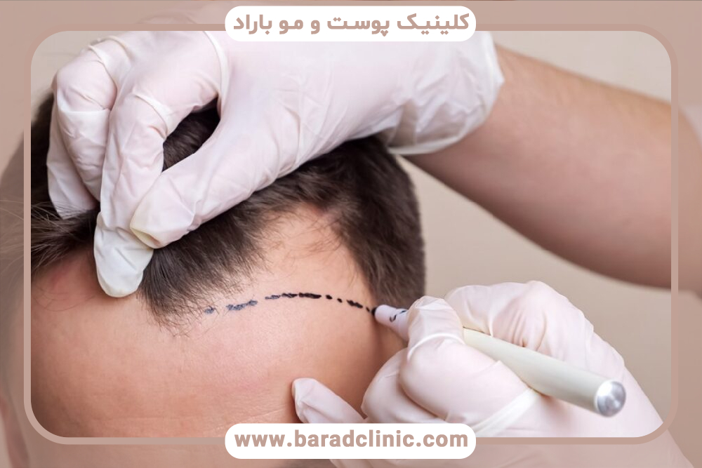 کاشت مو به روش میکروگرافت و بررسی مزایا و معایب