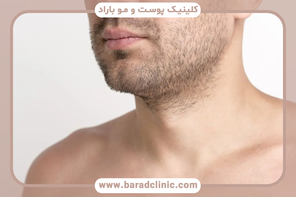 مراقبت‌های بعد از کاشت ریش