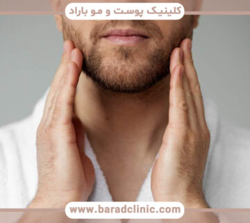 آیا کاشت ریش درد دارد؟ مزایا و معایب آن چیست
