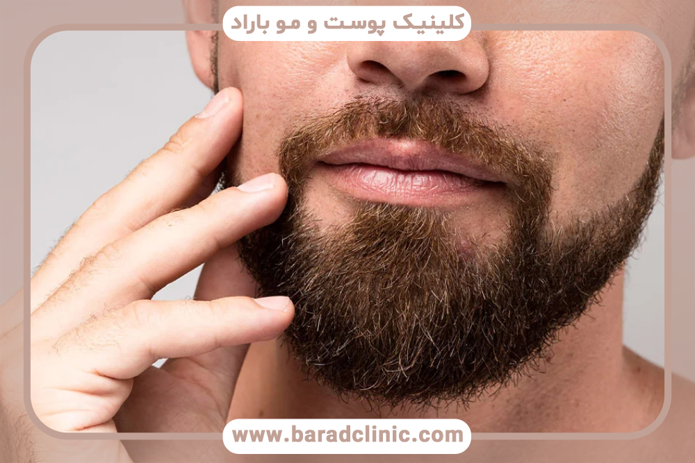 کاشت ریش برای نوجوانان و جوانان مناسب است؟