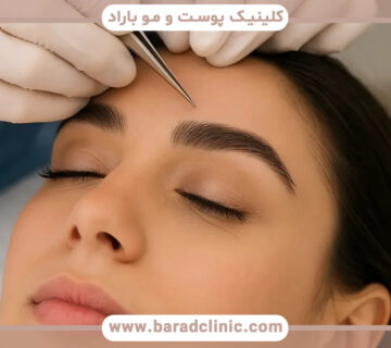 کاشت ابروی طبیعی