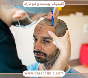 بهترین روشهای کاشت مو در ایران