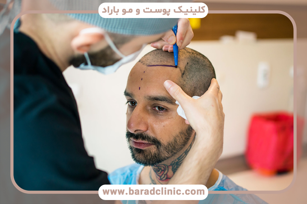 بهترین روش‌های کاشت مو در ایران