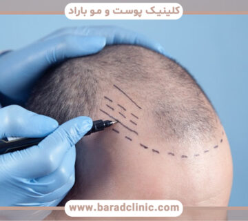 بهترین سن برای کاشت مو