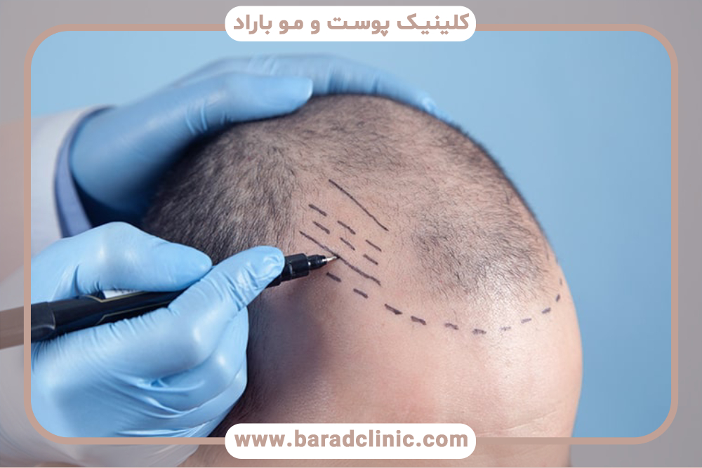 بهترین سن برای کاشت مو