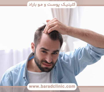 ورم بعد از کاشت مو