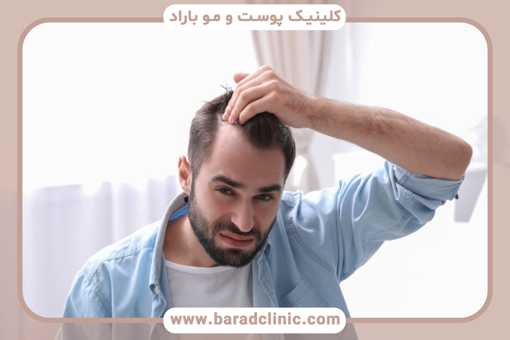 ورم بعد از کاشت مو