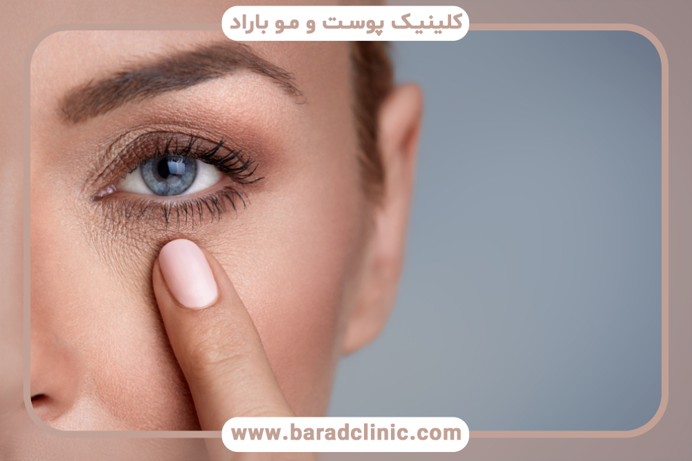 کاهش چین و چروک اطراف چشم