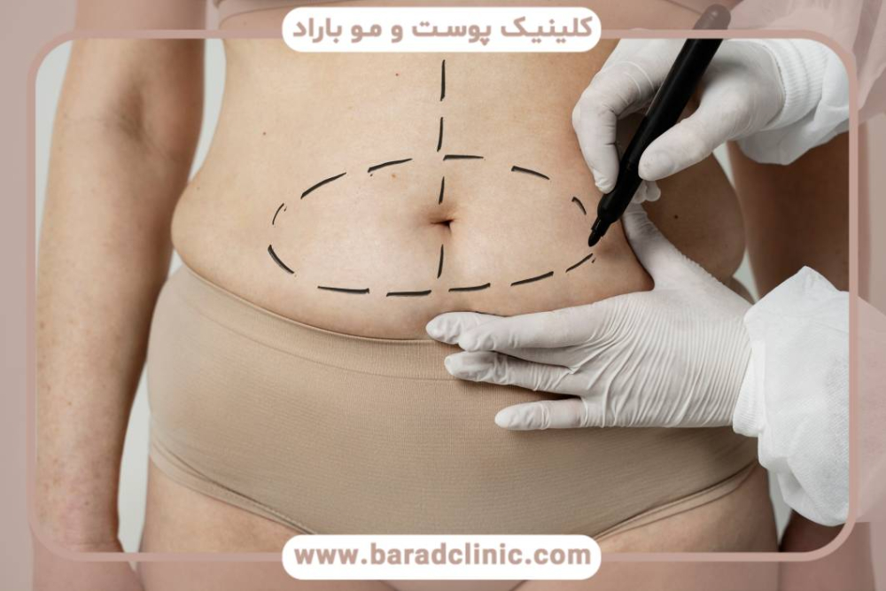 ابدومینوپلاستی